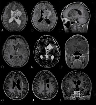 Case report: Atypical teratoid/rhabdoid tumor of the lateral ventricle in a male adolescent (case-based review and diagnostic challenges in developing countries)